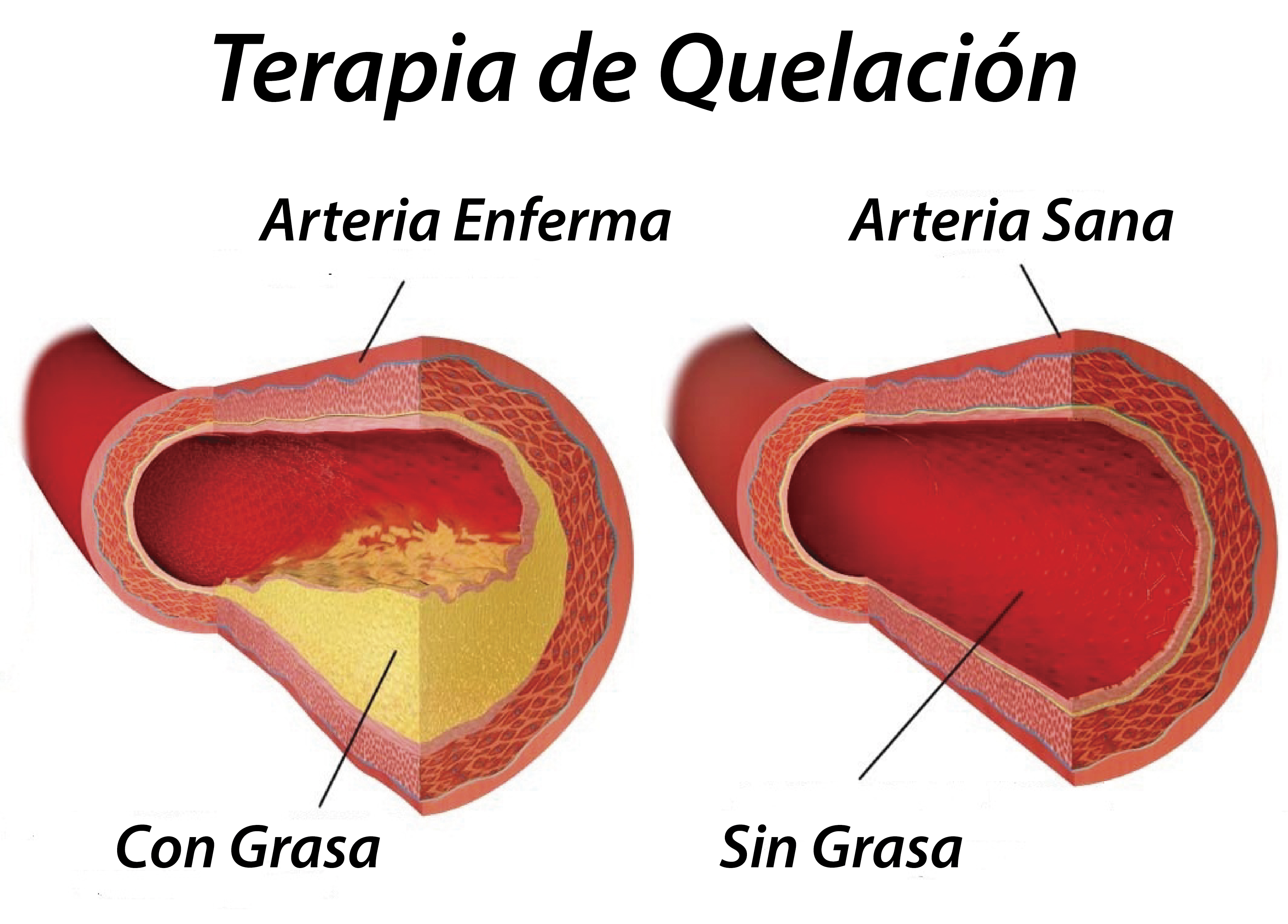 Terapia Por Quelación